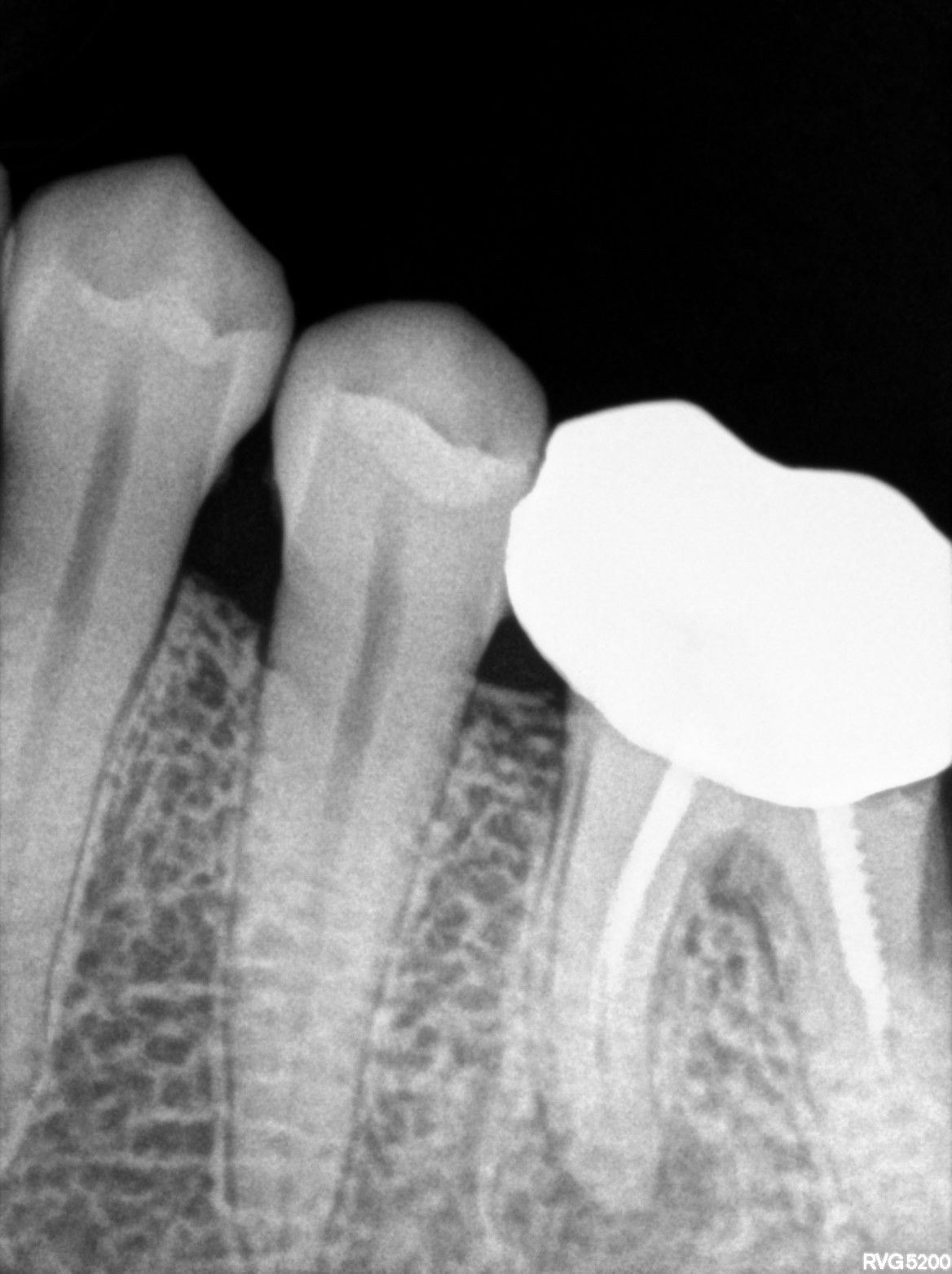 Dental X-ray